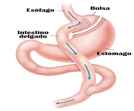 Bypass Gástrico