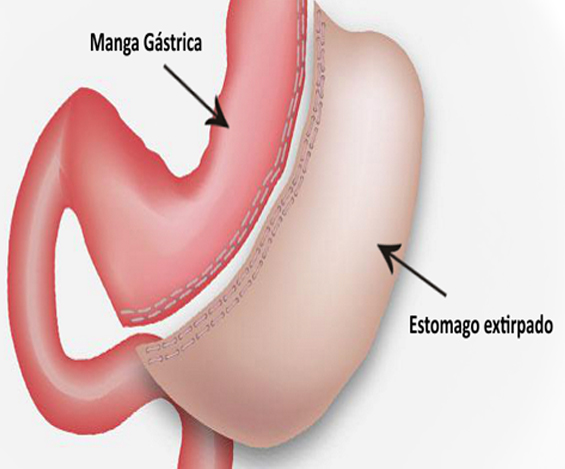 Manga Gástrica